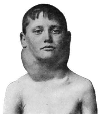 Fig. 80.—Chronic Hodgkin's Disease in a boy æt. 11.